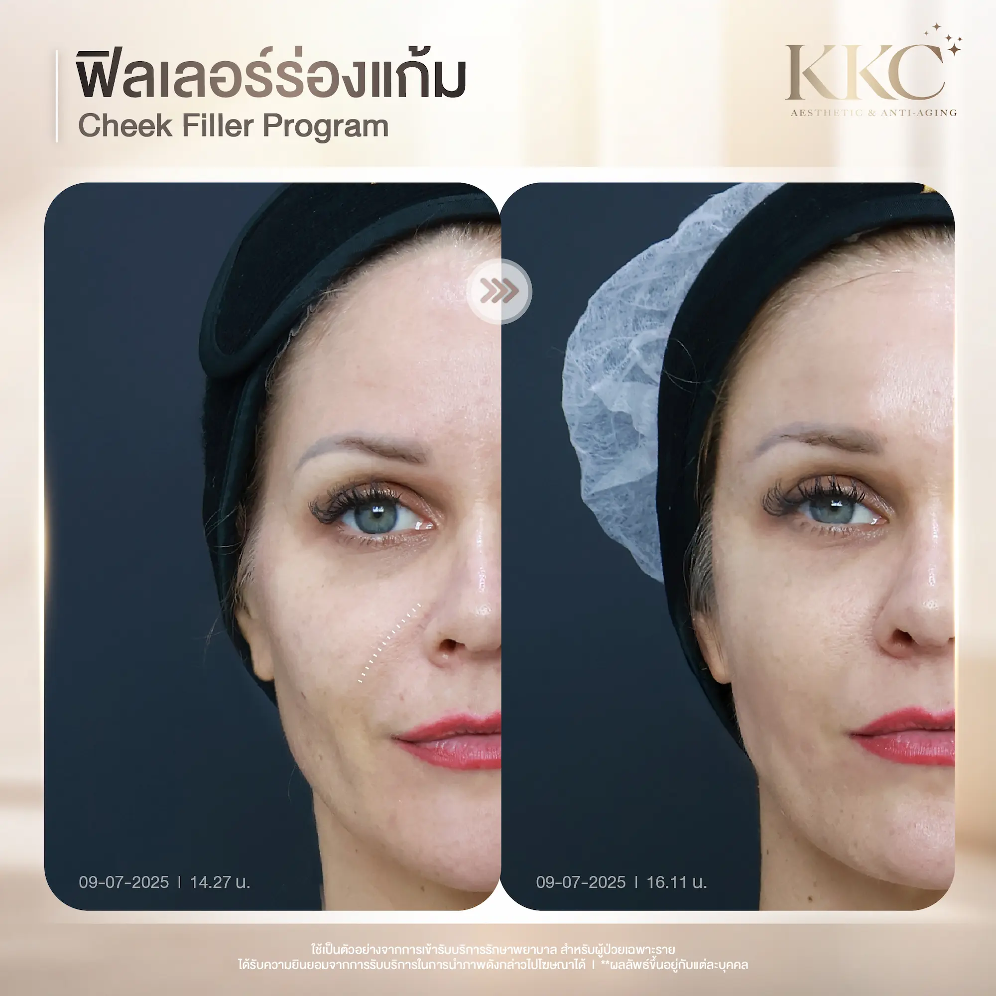 cheek-filler-lift-volume-review-kkc-clinic