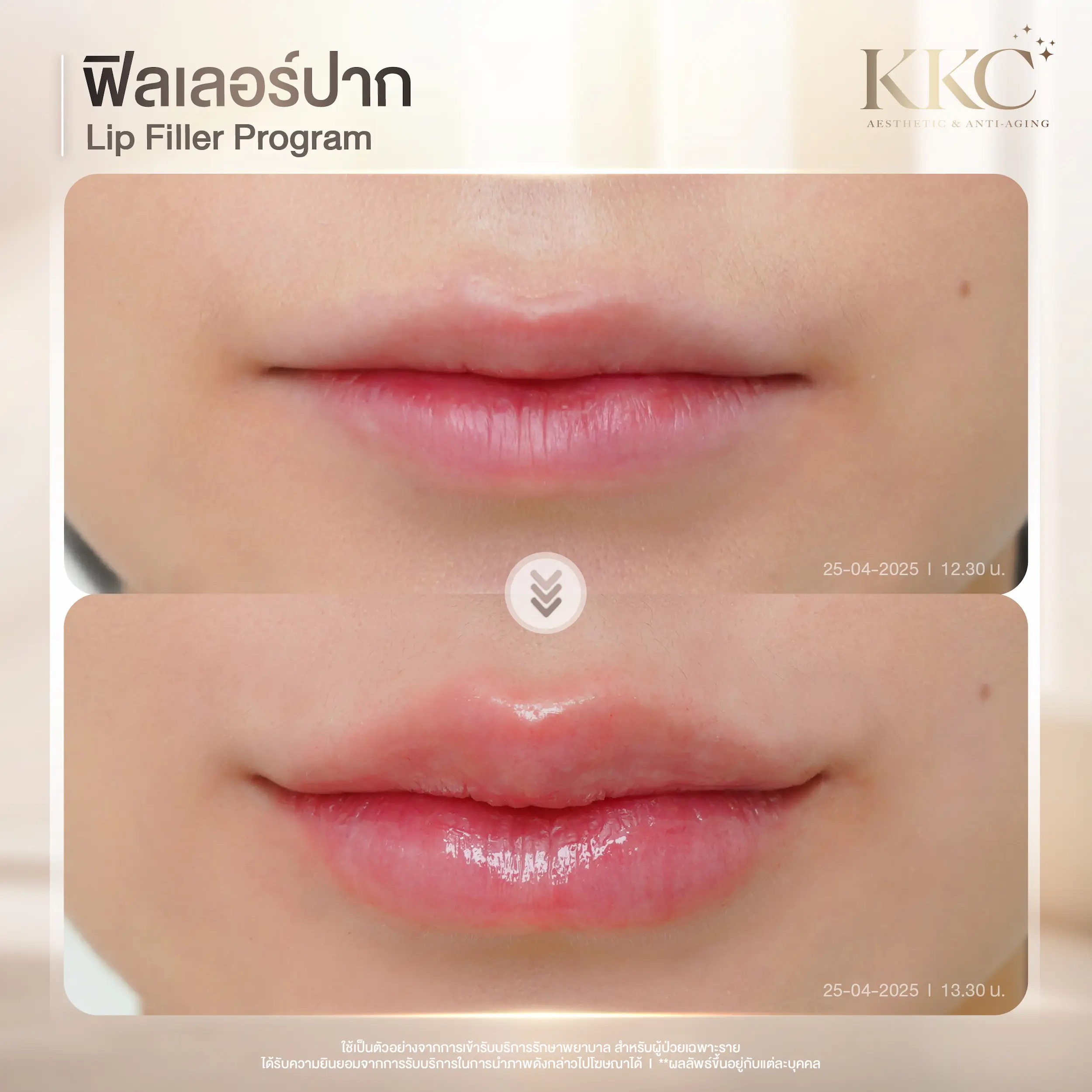 cherry-lips-shape-filler-injection-kkc-clinic