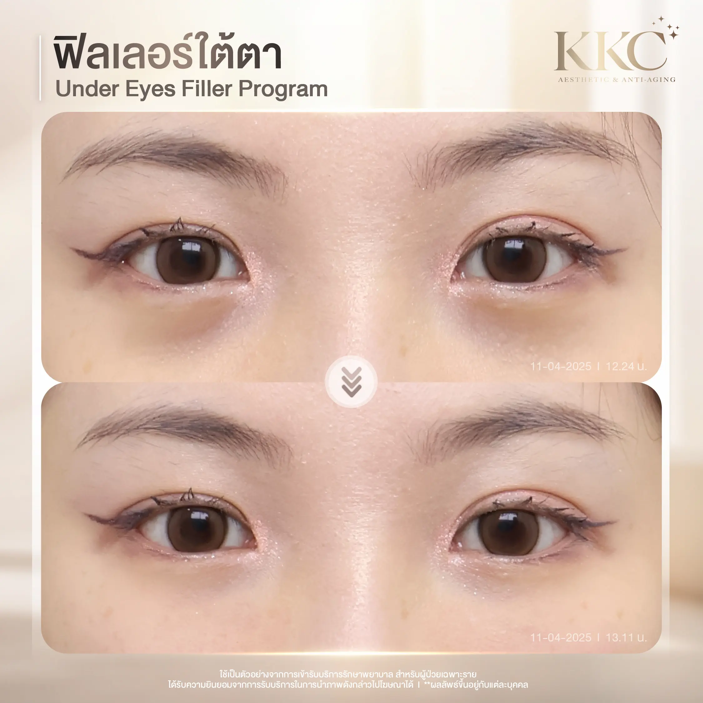 deep-tear-trough-filler-specialist-kkc-clinic