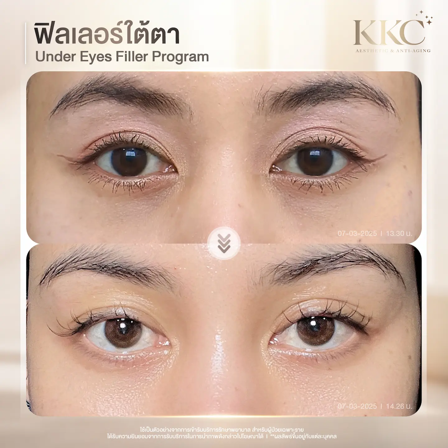 eye-rejuvenation-filler-before-after-results-kkc-clinic