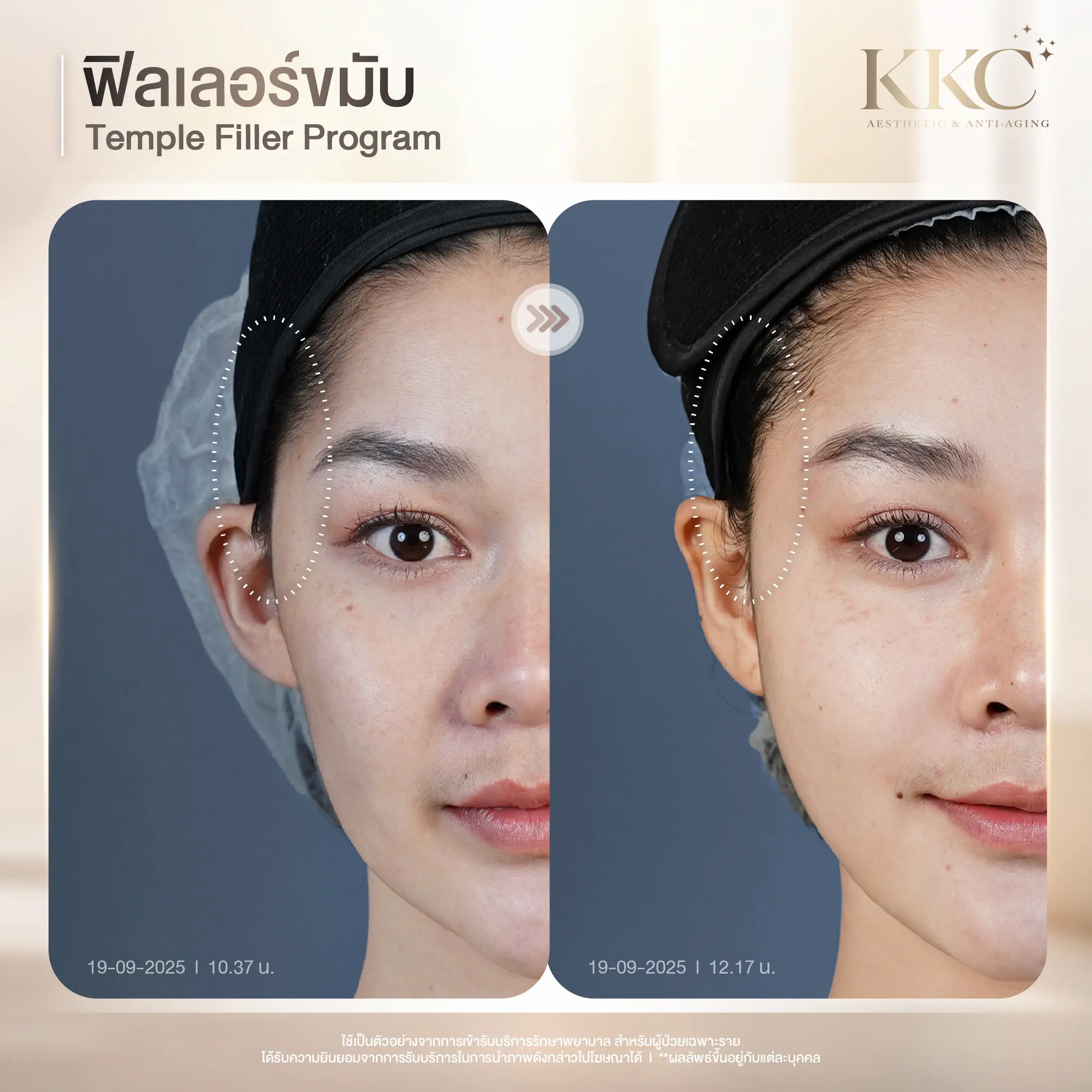 facial-balance-temple-filler-injection-kkc-clinic