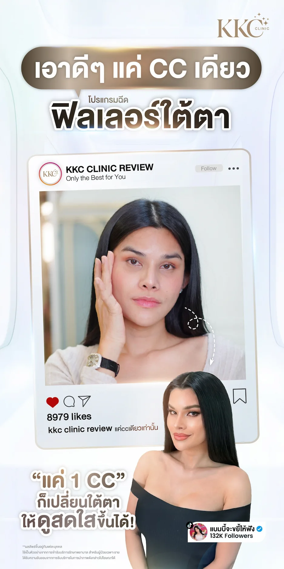 รีวิว ฉีดฟิลเลอร์ ใต้ตา 1 CC เปลี่ยนหน้าโทรมให้ดูสดใส รีวิวจากคุณแบมบี้จะขยี้ให้ฟัง