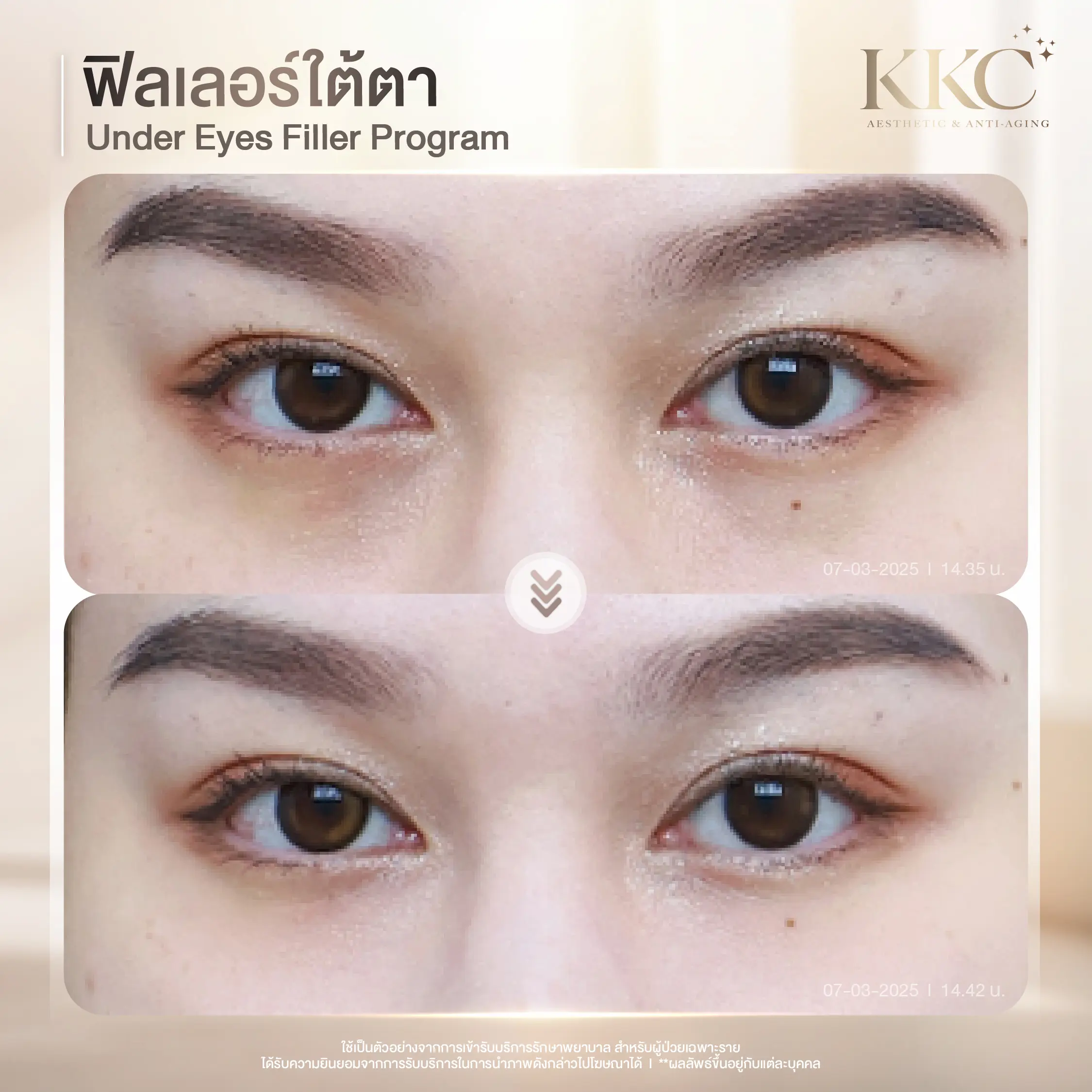 hollow-under-eye-fix-filler-kkc-clinic