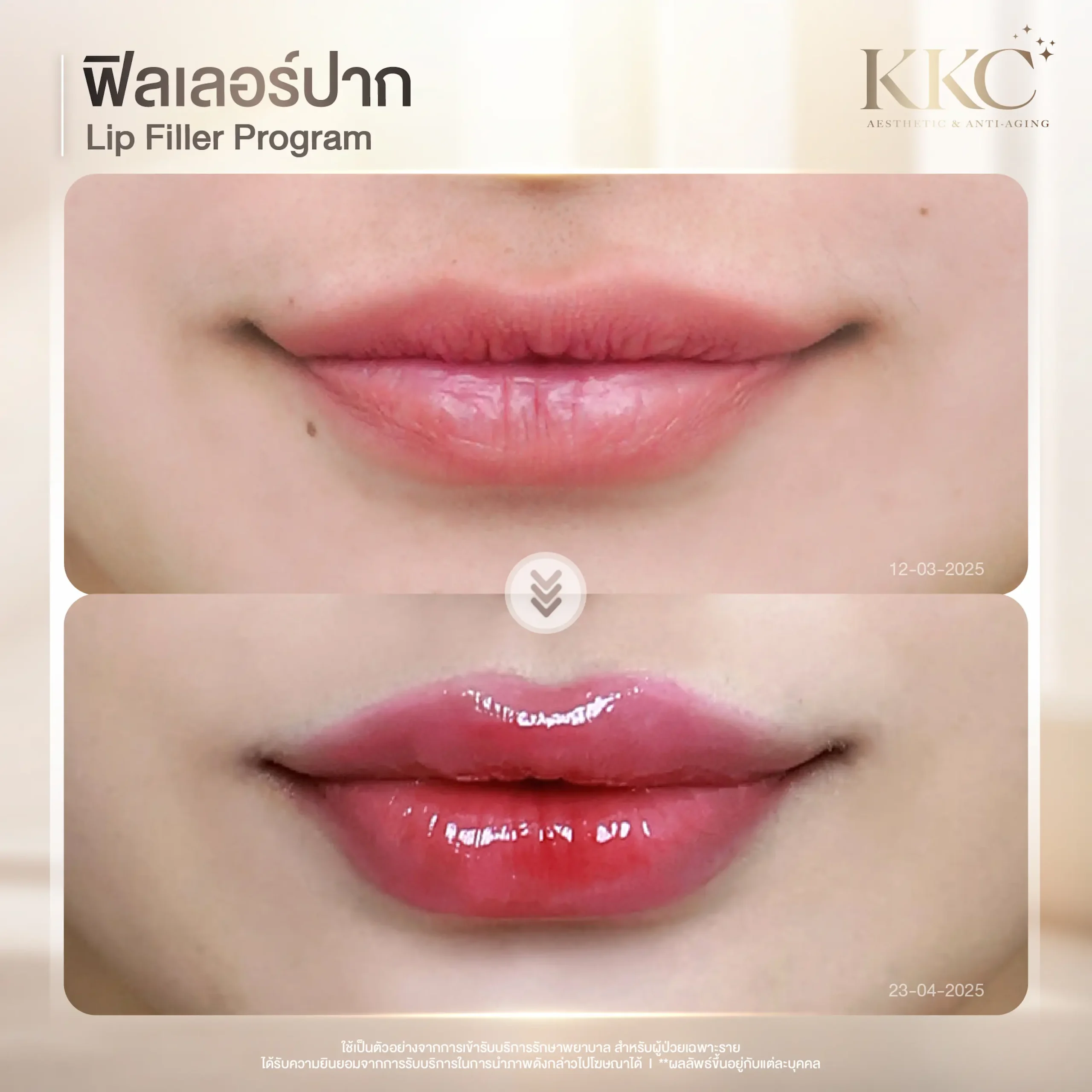 hydrated-lips-filler-before-after-review-kkc-clinic