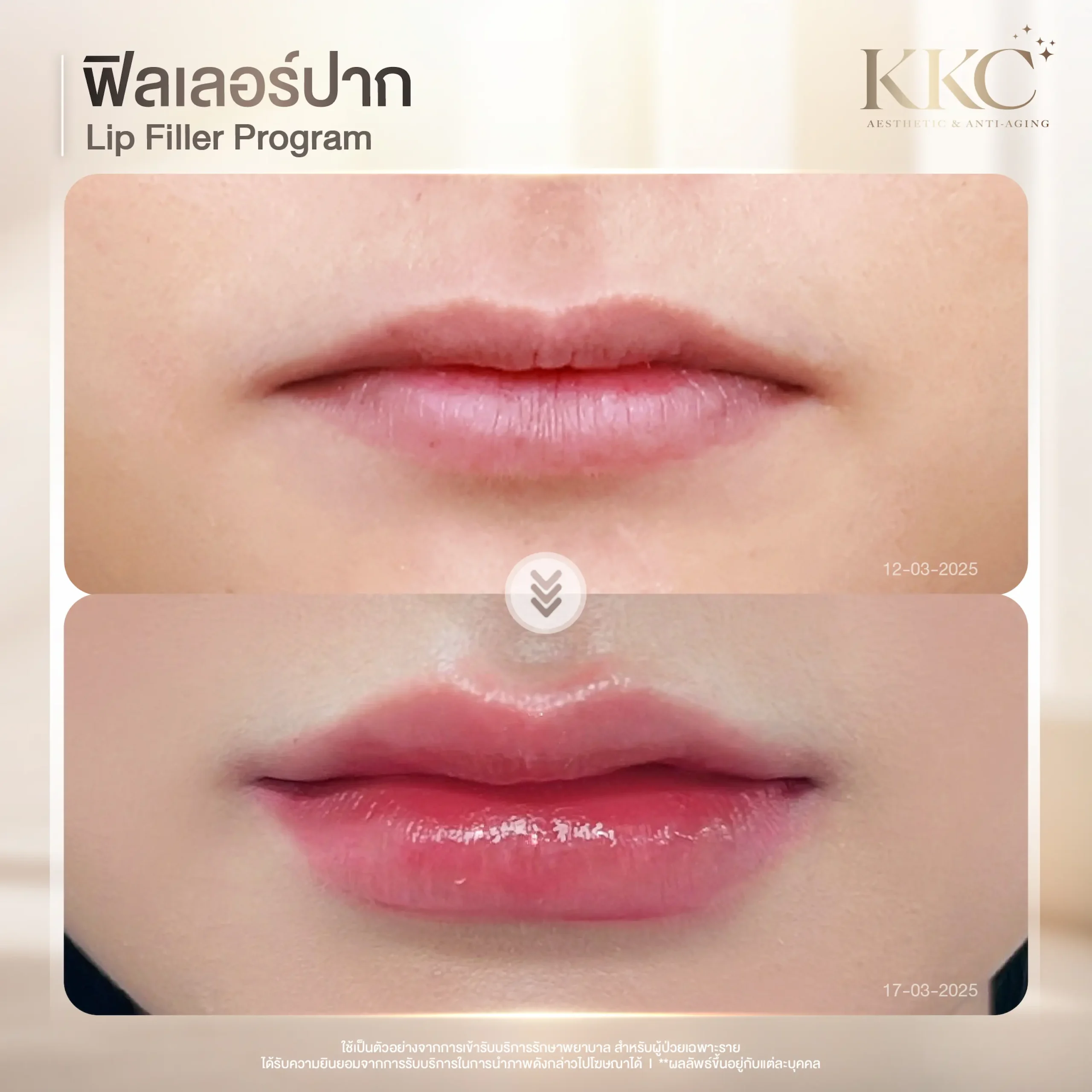 lip-filler-mouth-corner-lift-results-kkc-clinic