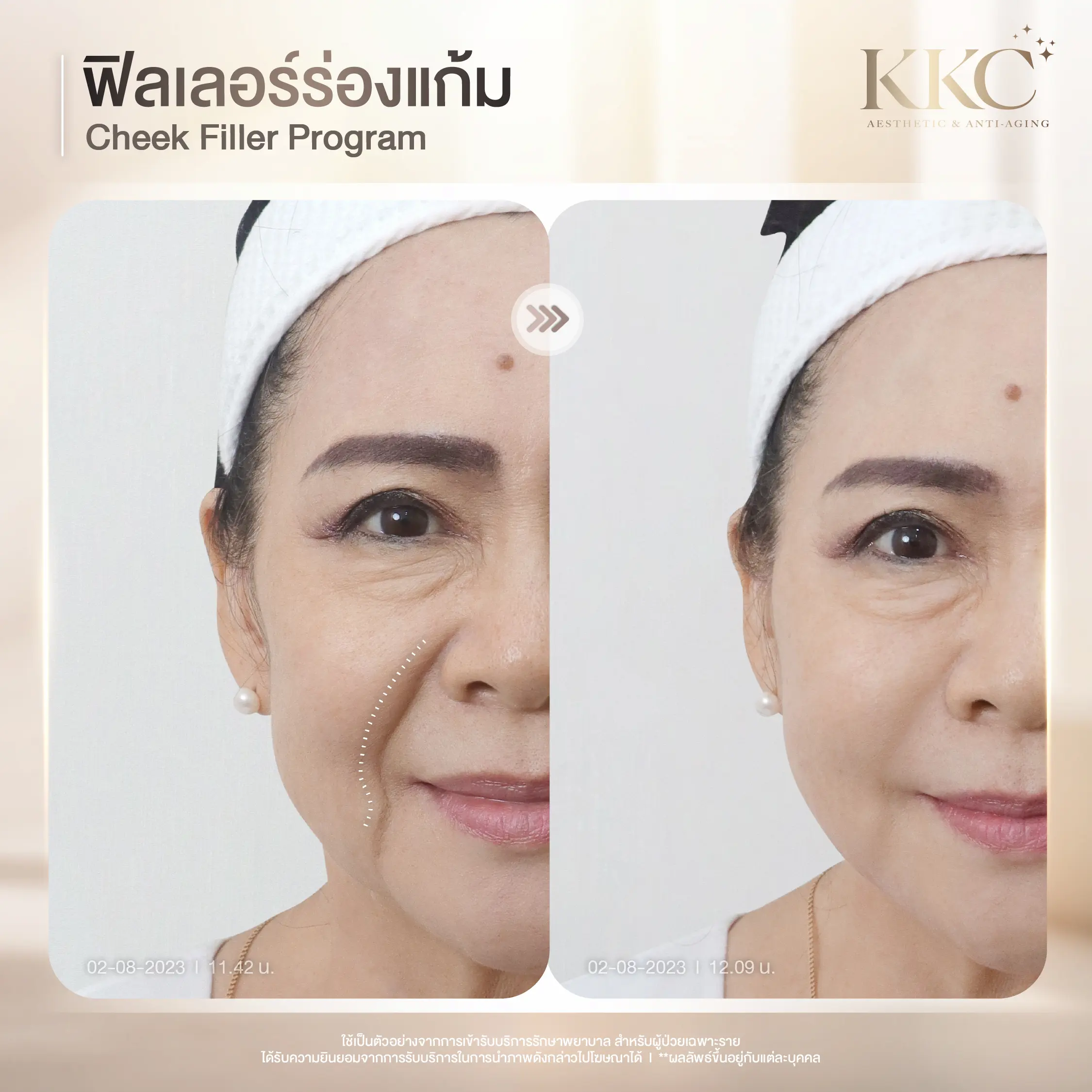 midface-filler-before-after-results-kkc-clinic