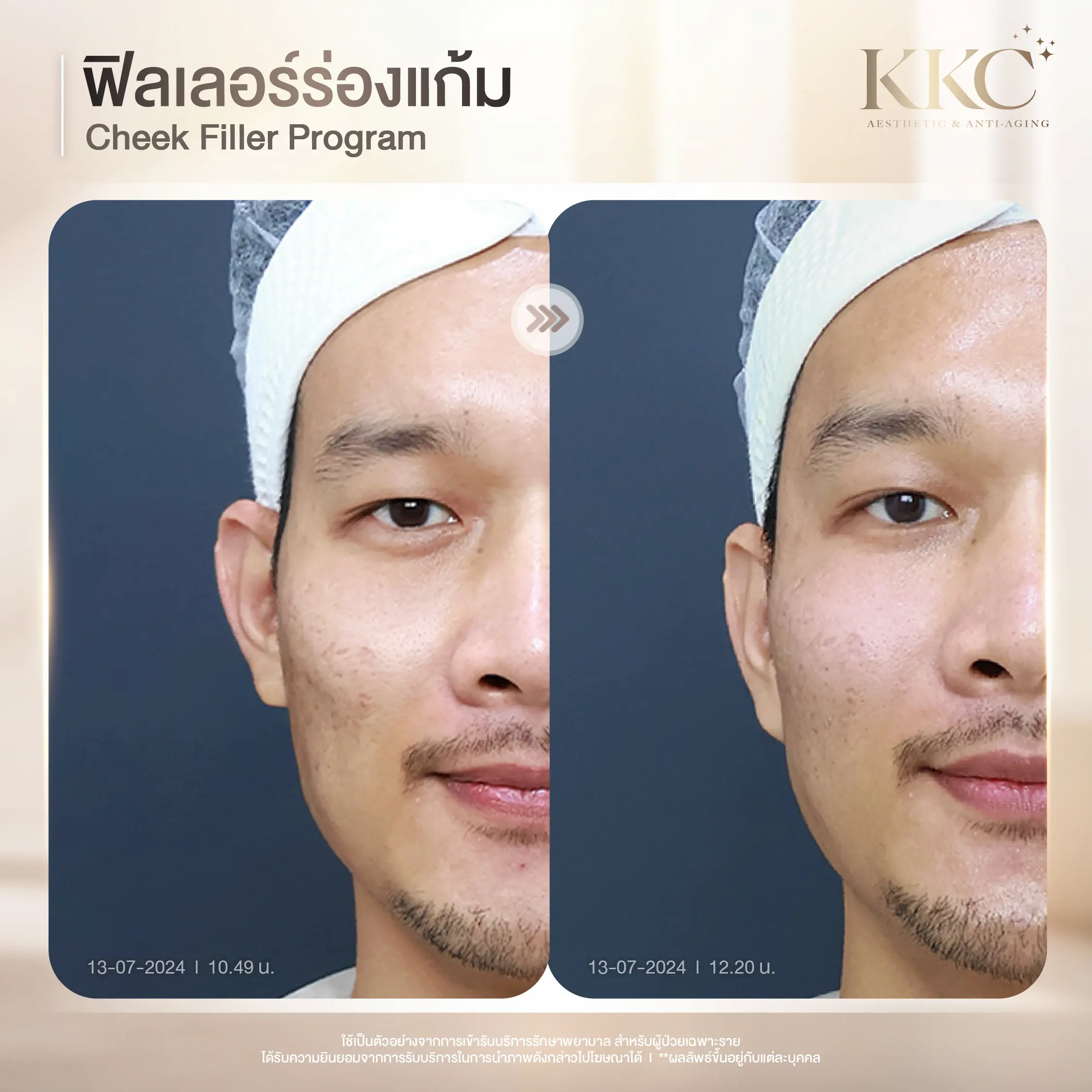 natural-cheek-augmentation-filler-kkc-clinic