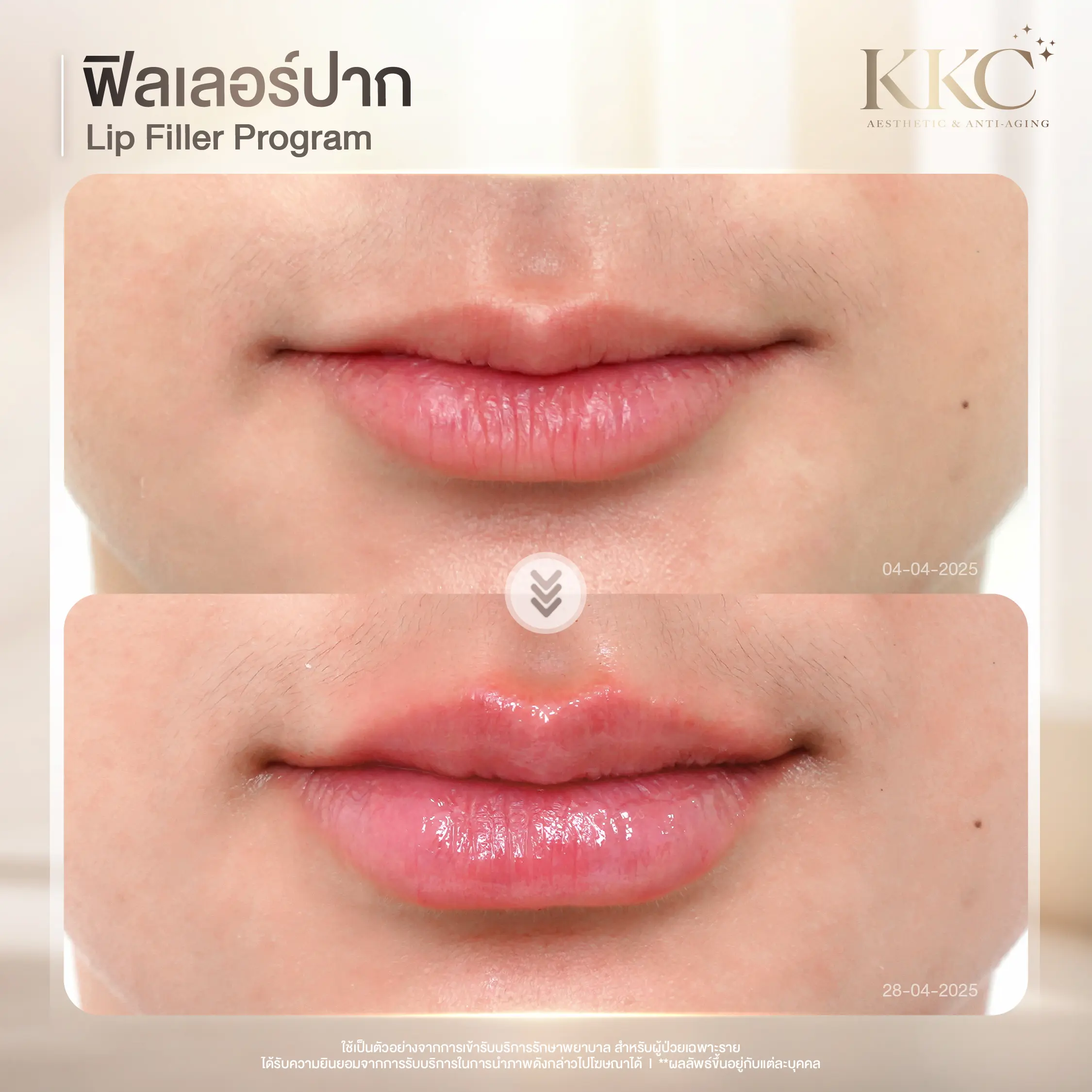 natural-lip-shape-filler-kkc-clinic