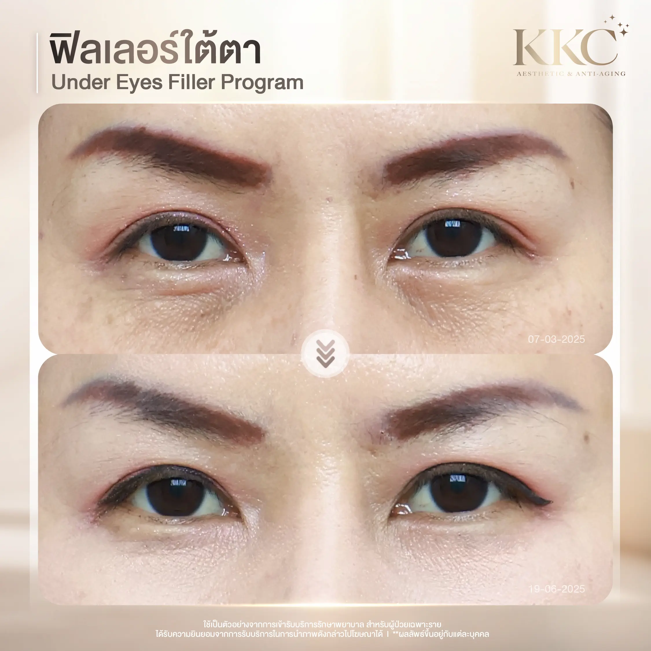 natural-under-eye-filler-result-kkc-clinic
