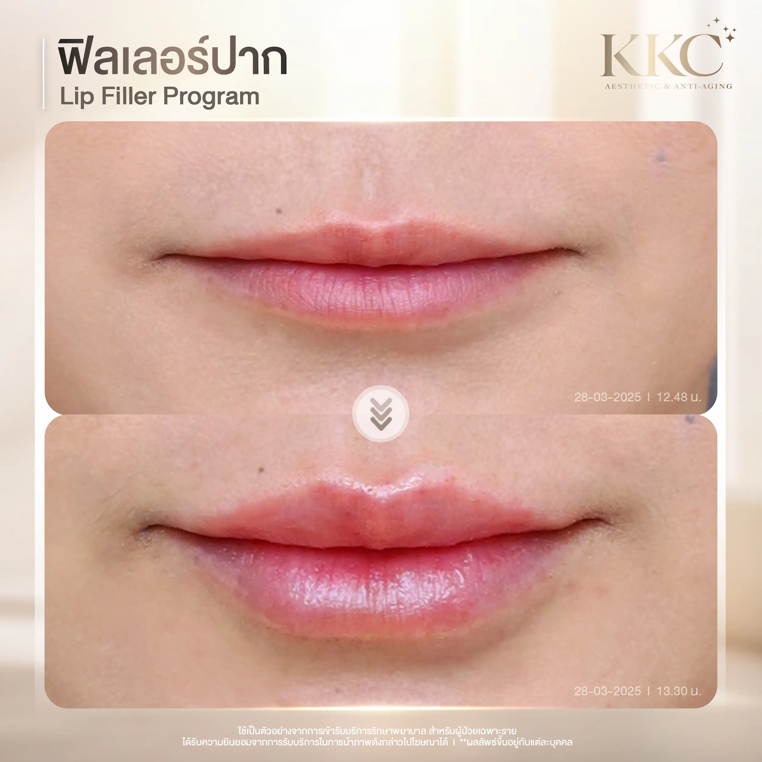 sexy-plump-lips-filler-review-kkc-clinic
