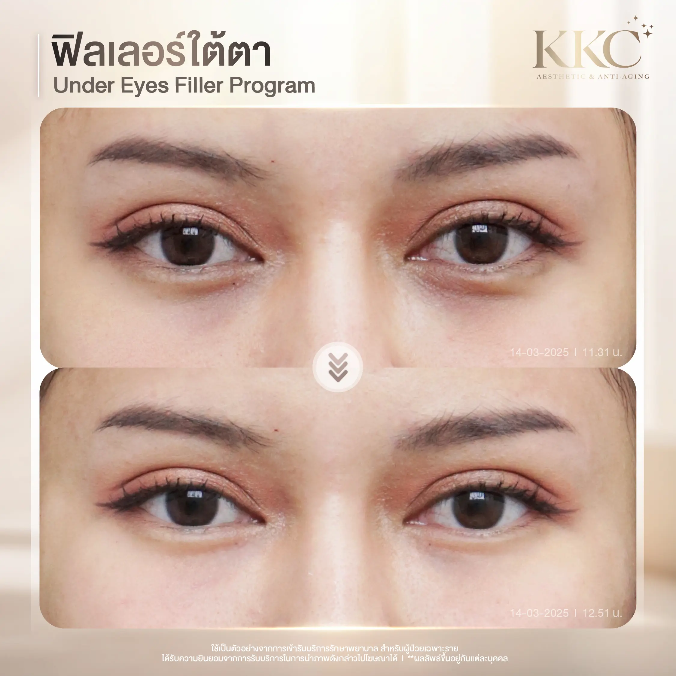 soft-filler-technique-under-eye-safety-kkc-clinic