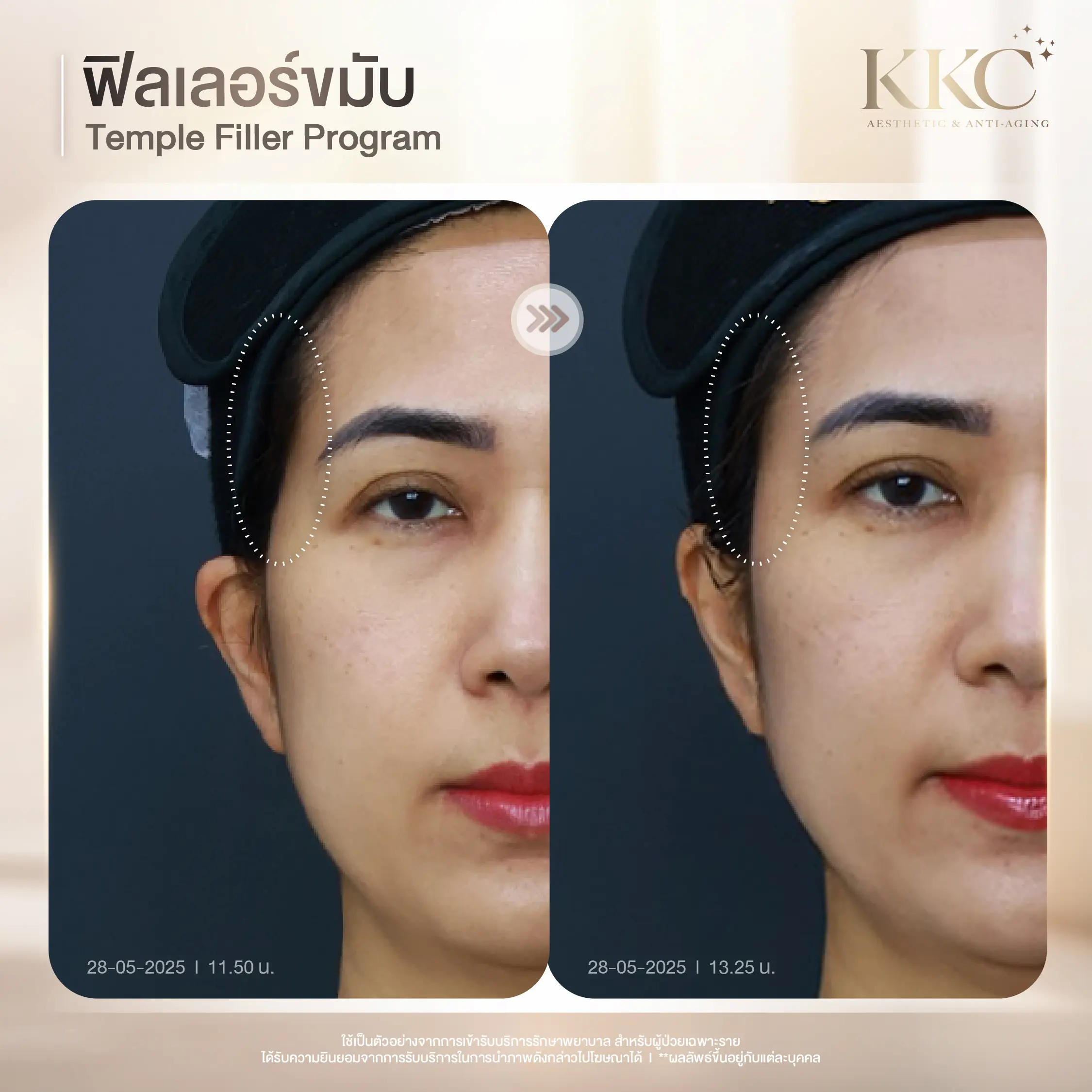 sunken-temple-correction-filler-kkc-clinic