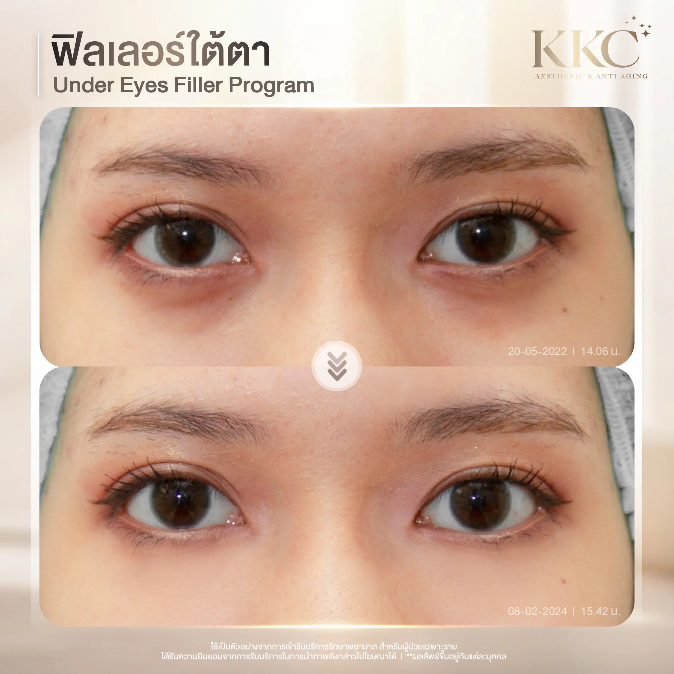tear-trough-filler-bag-removal-review-kkc-clinic