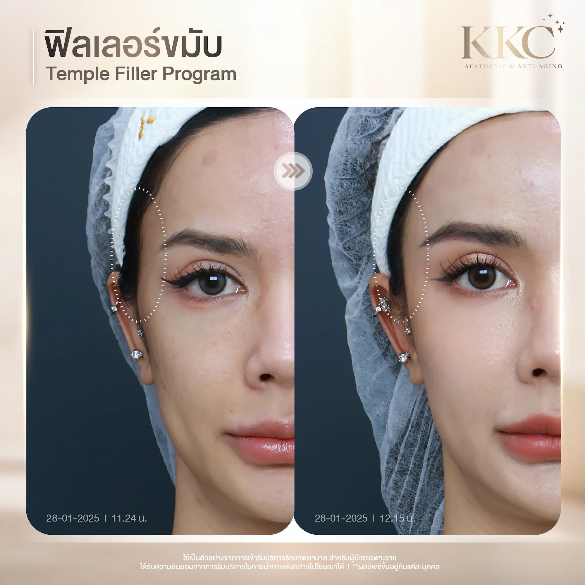 temple-filler-face-contouring-review-clinic