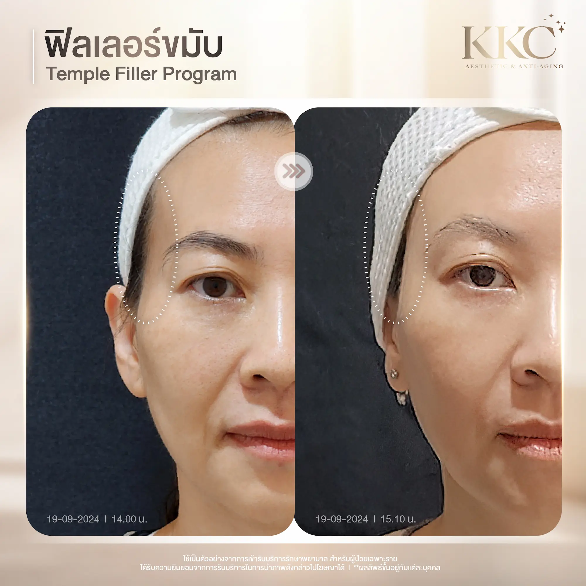 temporal-hollows-filler-before-after-kkc-clinic
