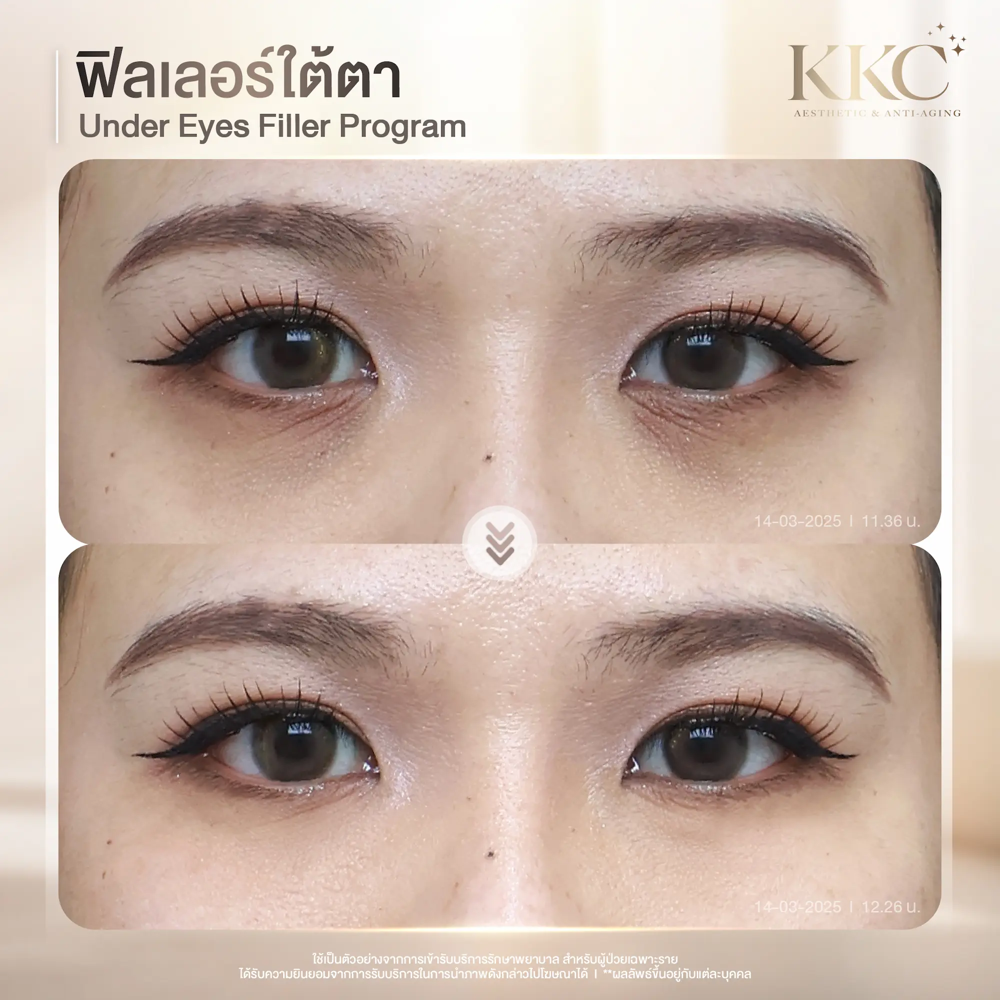 tired-eyes-solution-filler-injection-review-kkc-clinic