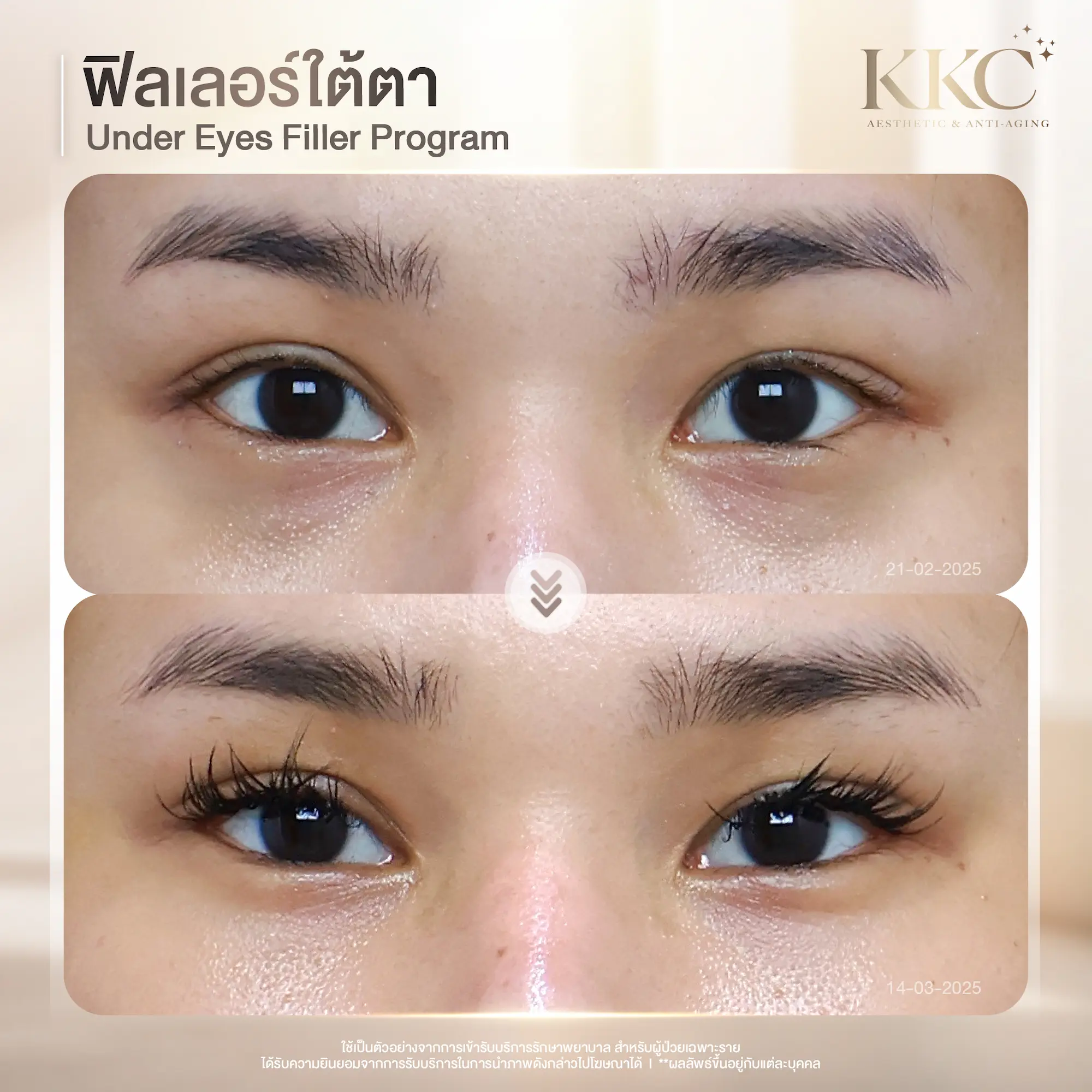 under-eye-bags-correction-filler-before-after-kkc-clinic