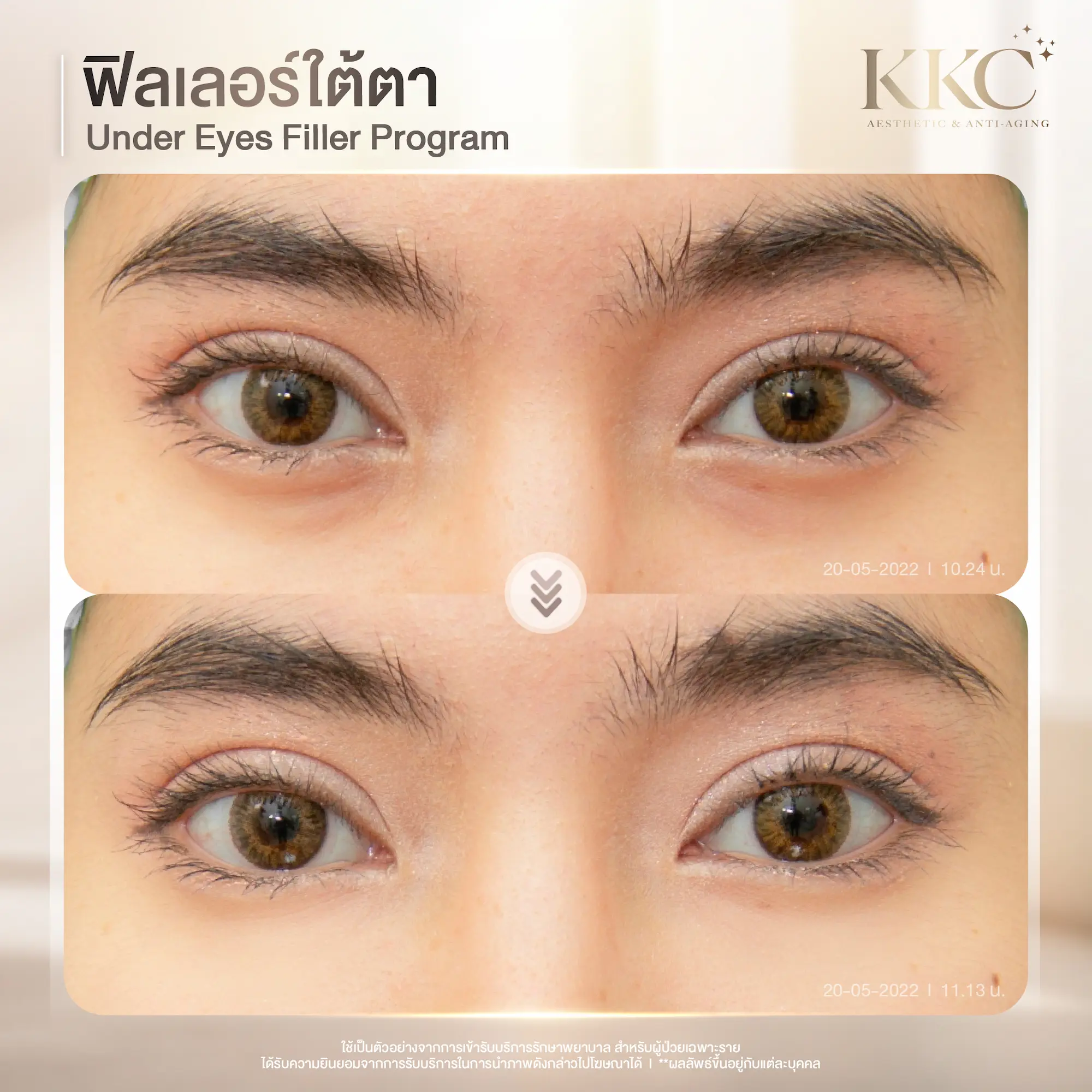 under-eye-filler-dark-circle-correction-kkc-clinic