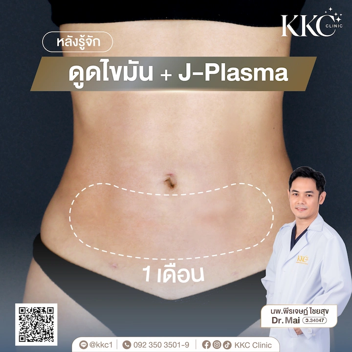 รีวิวหลังทำ 1 เดือน ดูดไขมัน KKC Clinic หน้าท้องแบนราบ ผิวเรียบเนียน ไม่เป็นคลื่น