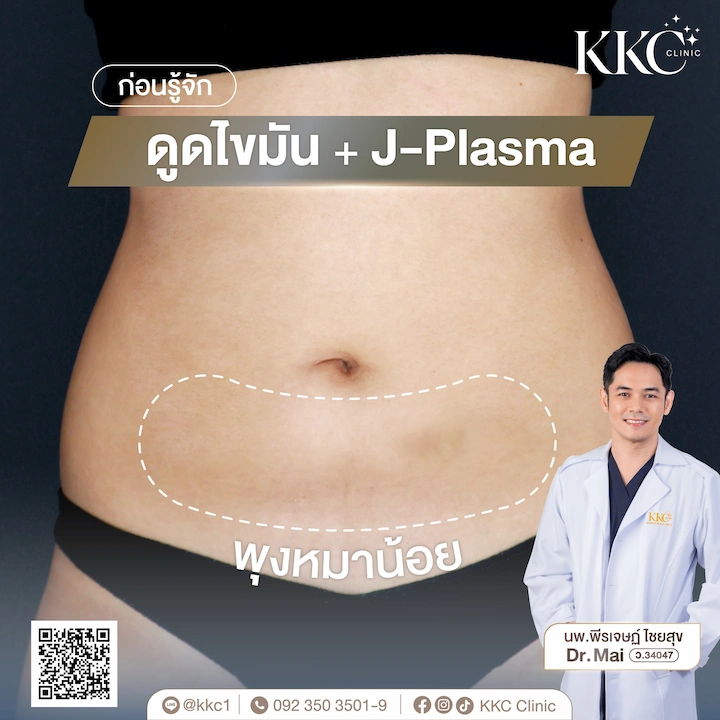 ภาพก่อนทำ ดูดไขมัน KKC Clinic แก้ปัญหาพุงหมาน้อย และความหย่อนคล้อยของหน้าท้อง