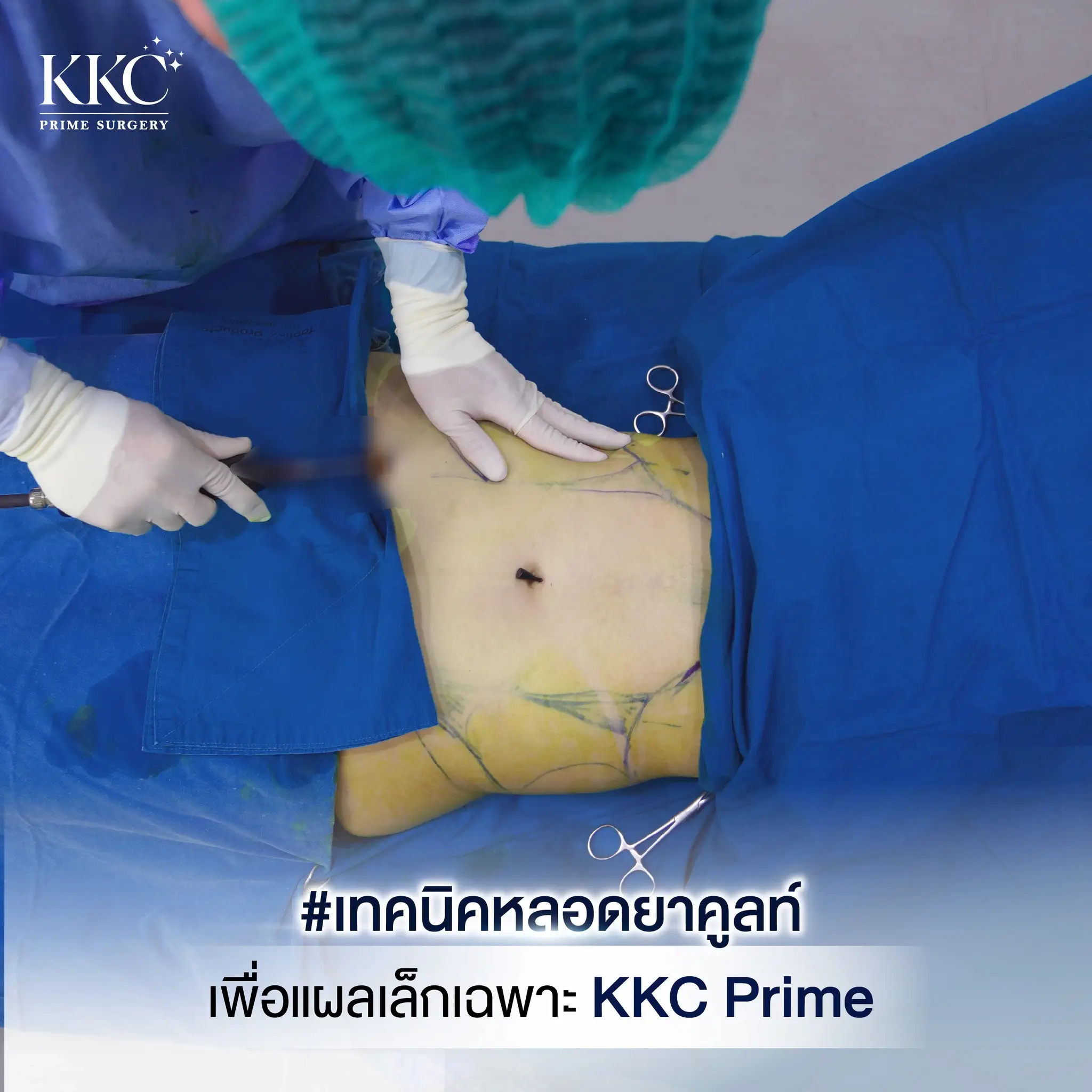 เทคนิคหลอดยาคูลท์ ดูดไขมัน แผลเล็ก โดย หมอพีรเจษฏ์