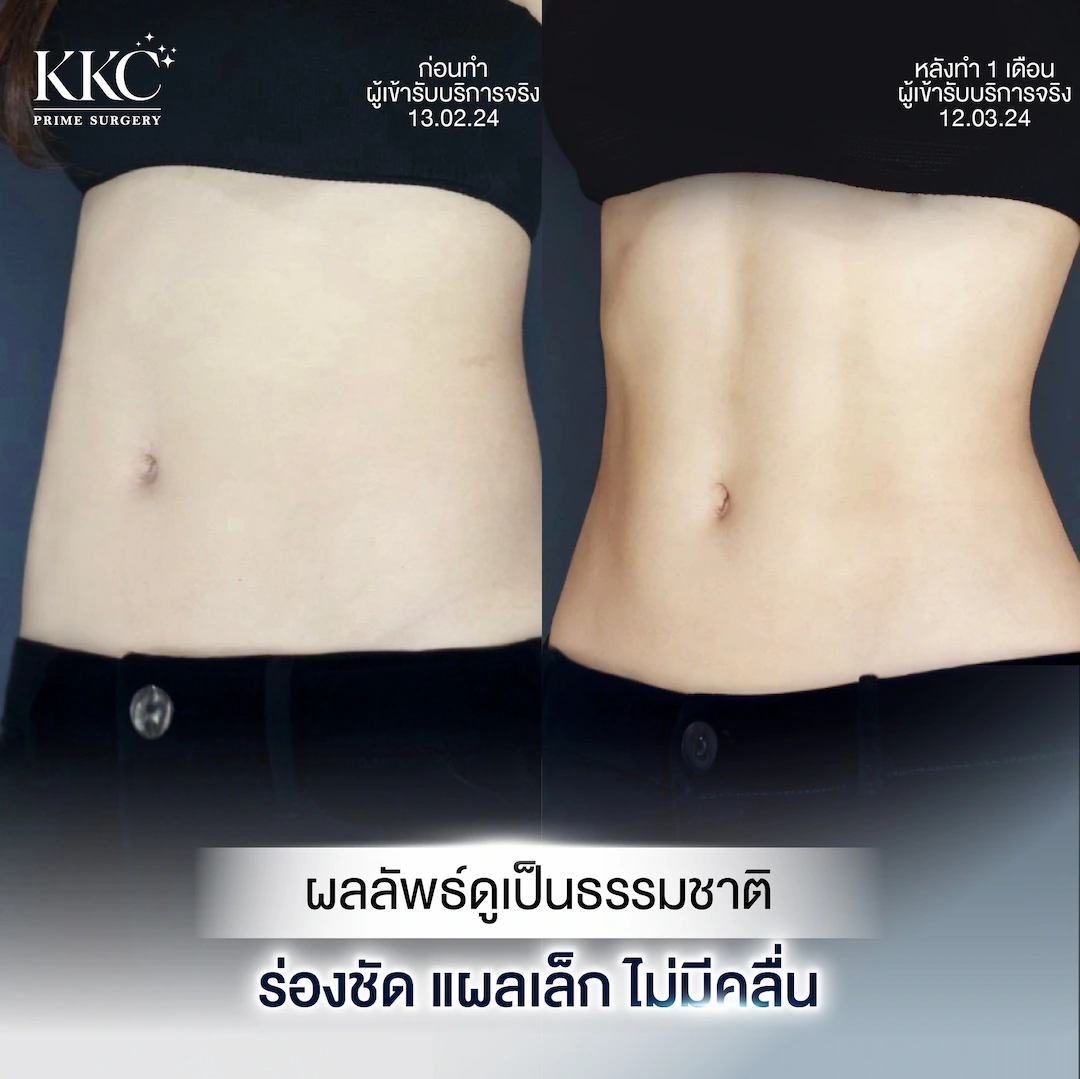 รีวิว ดูดไขมัน หมอพีรเจษฏ์ ร่อง 11 ชัด แผลเล็ก ไม่เป็นคลื่น