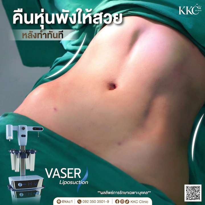 รีวิวหลังทำทันที ดูดไขมัน หน้าท้องแบนราบ โดยหมอใหม่ KKC