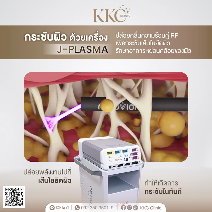 เครื่อง J-Plasma กระชับผิวหลังดูดไขมัน ช่วยให้ผิวเฟิร์ม ไม่ย้วย ไม่เป็นคลื่น
