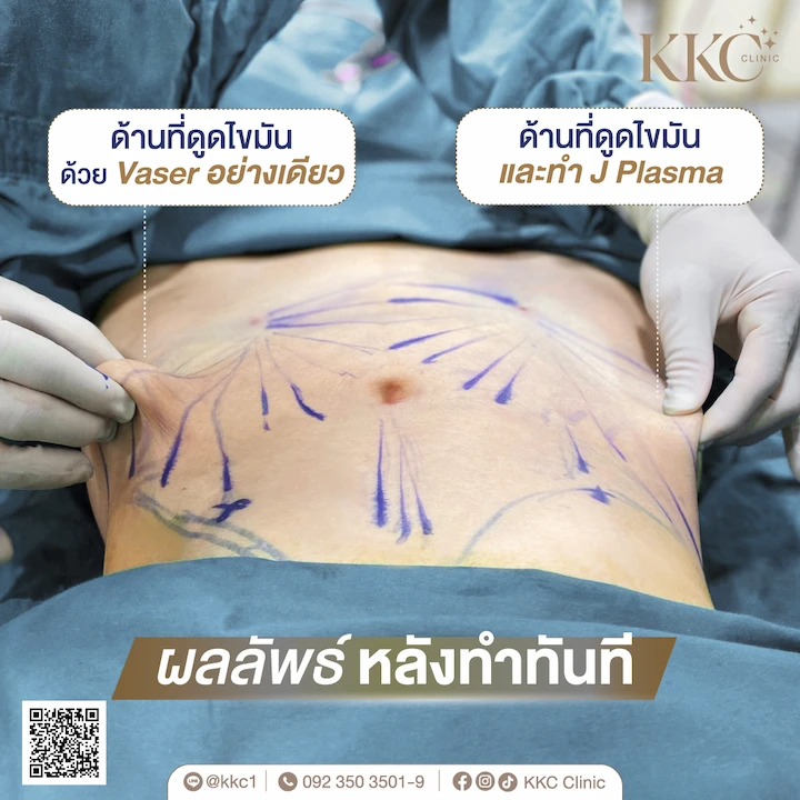 liposuction-kkc-clinic-intra-op-comparison-vaser-vs-j-plasma-skin-retraction