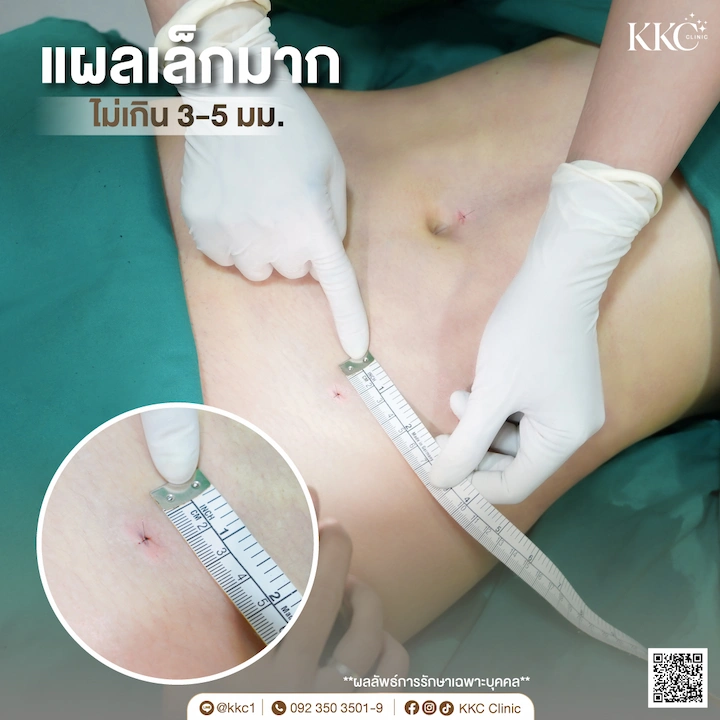 แผลดูดไขมันเล็กมาก ขนาด 3 มม. เทคนิคหมอใหม่ ไม่เป็นรอยตะขาบ