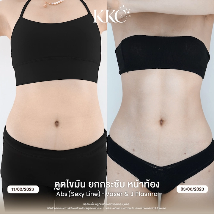 รีวิว ดูดไขมันยกกระชับหน้าท้อง ผิวเฟิร์ม ไม่ย้วย ด้วยเทคนิค J-Plasma