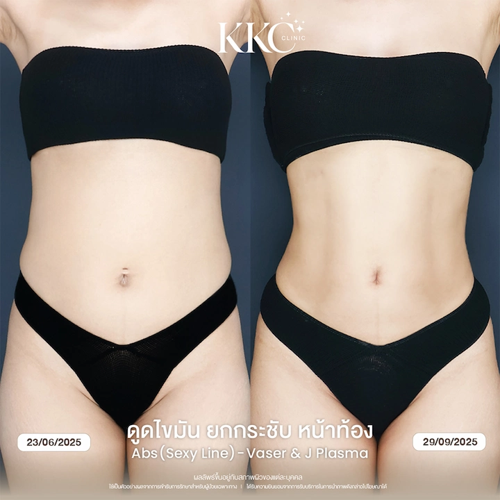 รีวิว ดูดไขมันยกกระชับหน้าท้อง ผิวเฟิร์ม ไม่ย้วย ด้วยเทคนิค J-Plasma