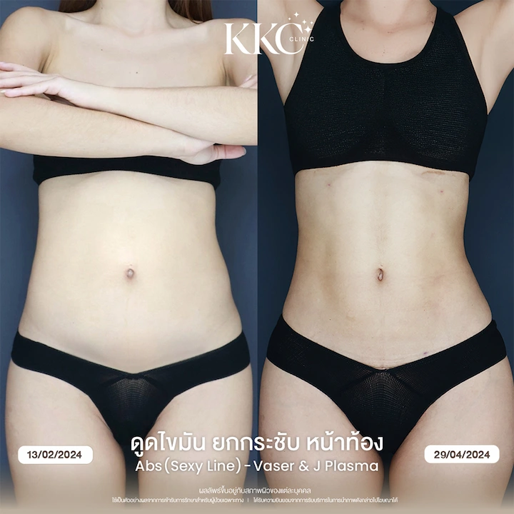 รีวิว ดูดไขมันยกกระชับหน้าท้อง ผิวเฟิร์ม ไม่ย้วย ด้วยเทคนิค J-Plasma