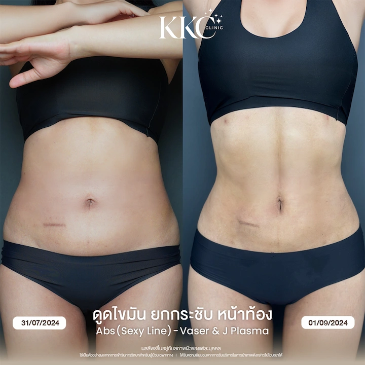 รีวิว ดูดไขมันยกกระชับหน้าท้อง ผิวเฟิร์ม ไม่ย้วย ด้วยเทคนิค J-Plasma