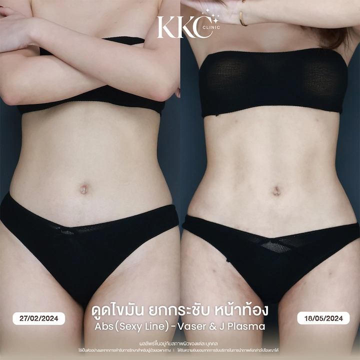 รีวิว ดูดไขมันยกกระชับหน้าท้อง ผิวเฟิร์ม ไม่ย้วย ด้วยเทคนิค J-Plasma