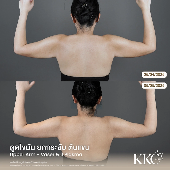 รีวิว ดูดไขมันยกกระชับต้นแขน มุมหลัง แก้แขนห้อยย้วย ให้ตึงกระชับ