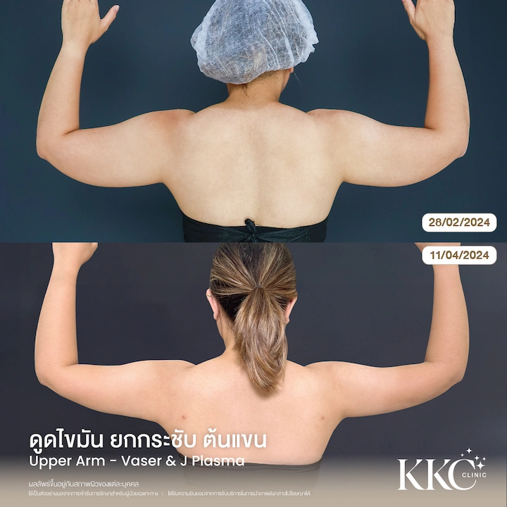 รีวิว ดูดไขมันยกกระชับต้นแขน มุมหลัง แก้ปัญหาไขมันสะสมเฉพาะจุด