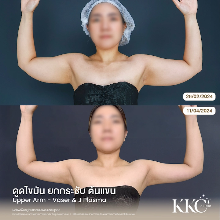 ภาพก่อน-หลัง ดูดไขมันยกกระชับต้นแขน มุมหน้า เผยไลน์กล้ามเนื้อแขนสวย