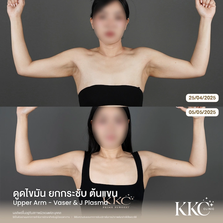 ผลลัพธ์ ดูดไขมันยกกระชับต้นแขน มุมหน้า ผิวเรียบเนียน ไม่เป็นคลื่น