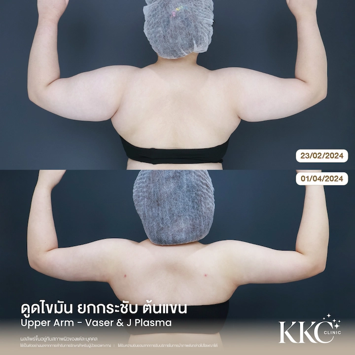 ผลลัพธ์ ดูดไขมันยกกระชับต้นแขน มุมหลัง แขนเล็กลง ผิวกระชับขึ้น