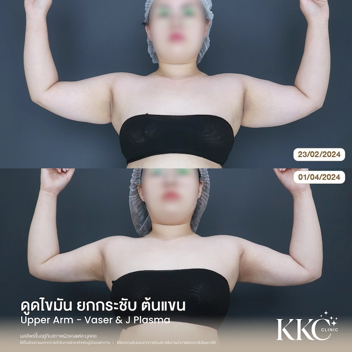 รีวิว ดูดไขมันยกกระชับต้นแขน มุมหน้า ลดขนาดต้นแขนอย่างชัดเจน