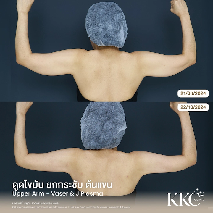 ภาพเปรียบเทียบ ดูดไขมันยกกระชับต้นแขน มุมด้านหลัง เก็บปีกแขน ผิวไม่ย้วย