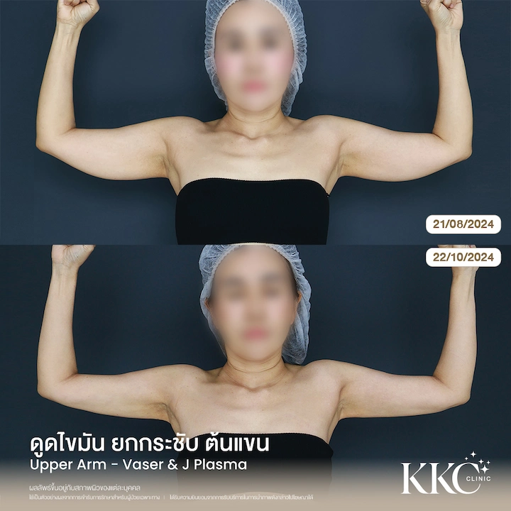 รีวิว ดูดไขมันยกกระชับต้นแขน มุมด้านหน้า เปลี่ยนแขนใหญ่ให้เรียวเล็กทันที