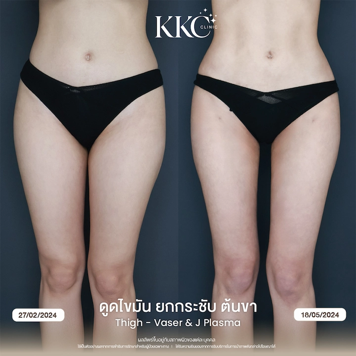 รีวิว ดูดไขมันยกกระชับต้นขา หลังทำ 3 เดือน ขาเล็กกระชับ ผลลัพธ์ชัดเจน