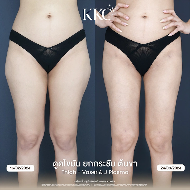 รีวิว ดูดไขมันยกกระชับต้นขา ลดปีกสะโพกด้านข้าง ปรับทรงขาให้ดูตรงสวย