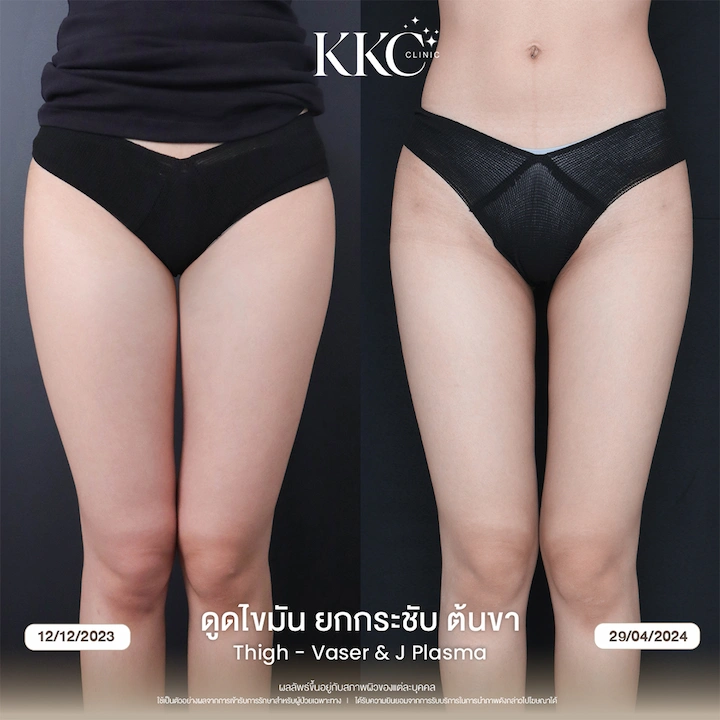 ผลลัพธ์หลังทำ 1 เดือน ดูดไขมันยกกระชับต้นขา ผิวเรียบเนียน ขาดูเฟิร์มขึ้น ไม่เป็นคลื่น
