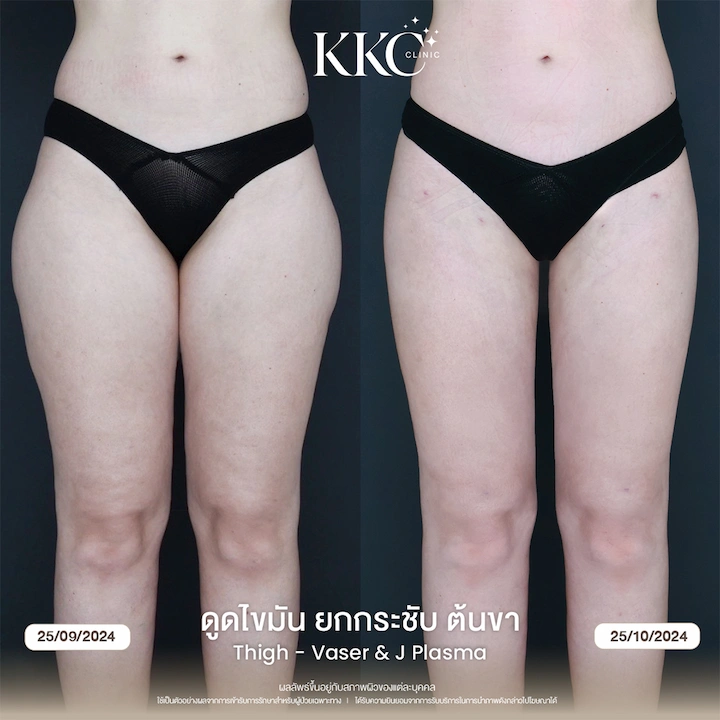 ภาพก่อน-หลัง ดูดไขมันยกกระชับต้นขา แก้ปัญหาขาเบียด สร้าง Thigh Gap ให้ขาดูสวย