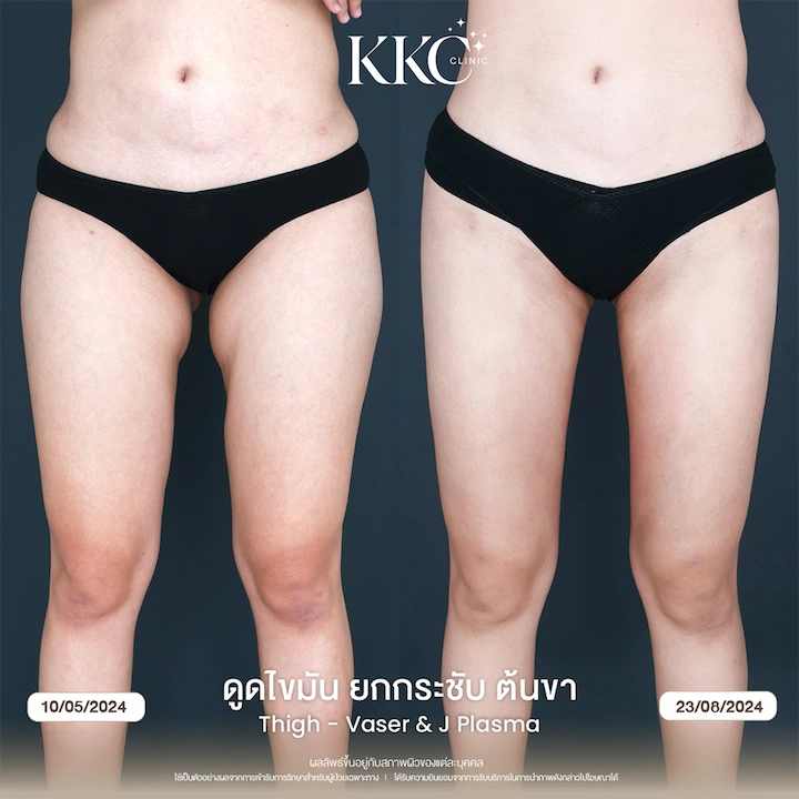 รีวิว ดูดไขมันยกกระชับต้นขา เปลี่ยนขาใหญ่ให้เรียวเล็ก สัดส่วนลดลงชัดเจน