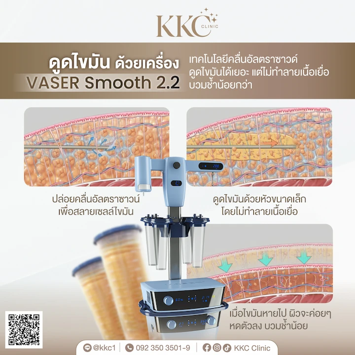 เครื่องดูดไขมัน VASER Smooth 2.2 เทคโนโลยีคลื่นอัลตราซาวด์ สลายไขมันนิ่มนวล บวมช้ำน้อย